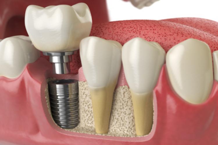 USING OF MAGNESIUM ALLOYS COVERED WITH BIOCOMPATIBLE MATERIALS AS BIODEGRADABLE DENTAL IMPLANTS